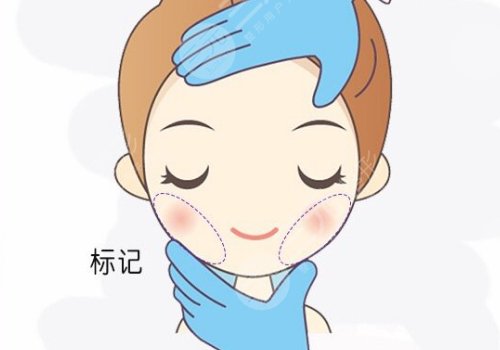 丰颜玻尿酸的优点