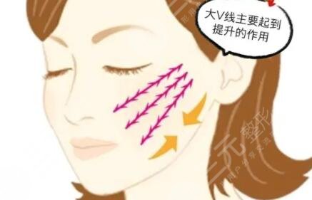 埋线提升