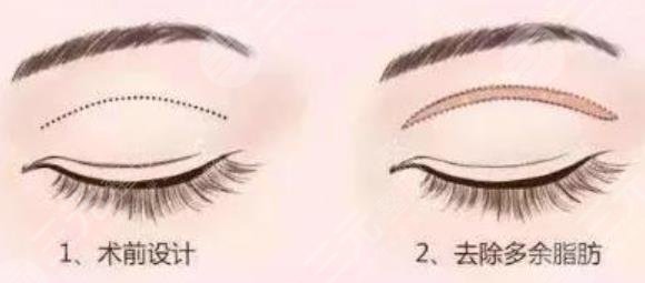 双眼皮手术