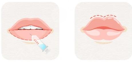 玻尿酸丰唇整形术怎么样,多少钱?价格&手术常识介绍!