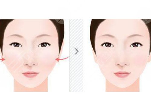 轮廓手术危险吗?