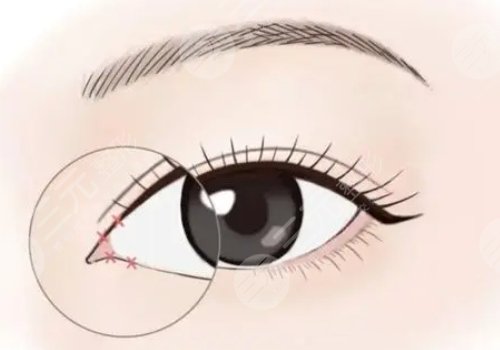 开眼角割双眼皮恢复期要多久？