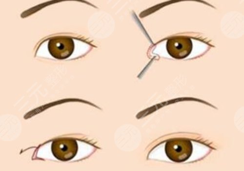 开眼角割双眼皮恢复期要多久？