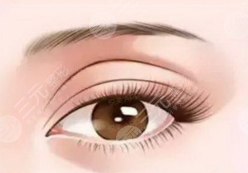 开眼角割双眼皮恢复期要多久？