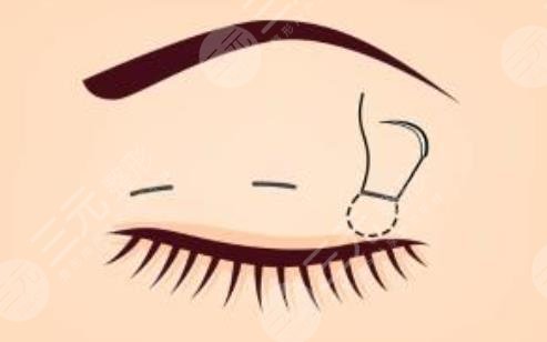 双眼皮修复