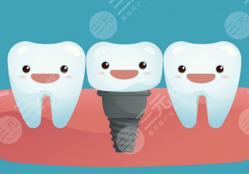 诺贝尔种植牙可以用多久