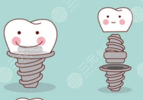 诺贝尔种植牙可以用多久