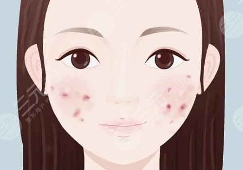 痘印怎么消除？