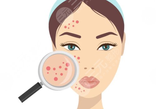 痘印怎么消除？