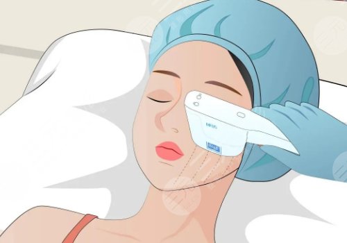 超声炮做一次全脸要多少钱？