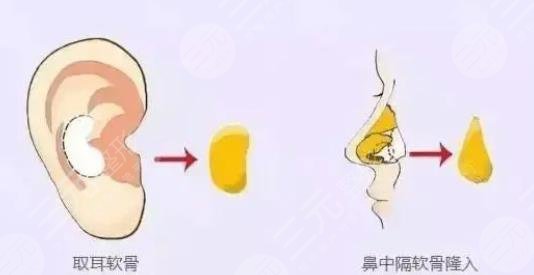 耳软骨复合隆鼻