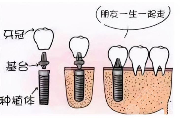 揭阳人民医院?种牙一颗大约多少钱?