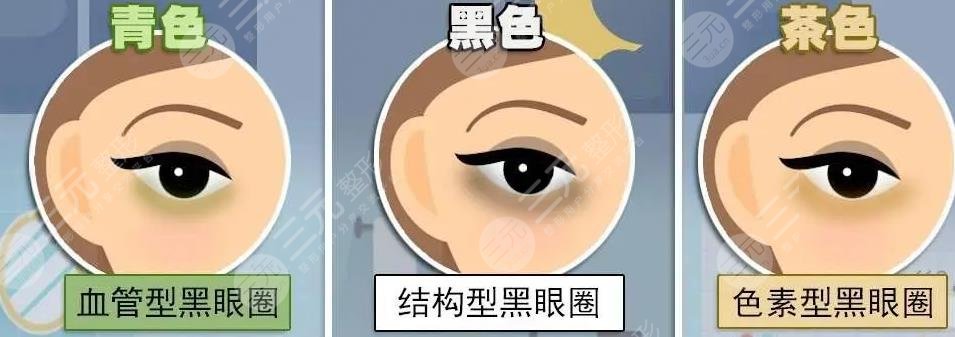形成黑眼圈的原因