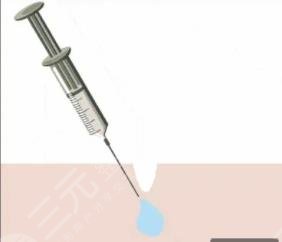 注射玻尿酸