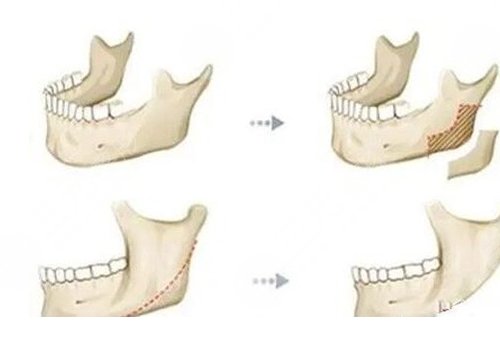 做轮廓手术多少钱费用是多少？