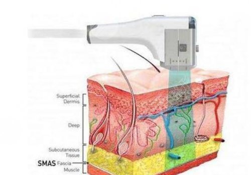 超声炮适合什么年龄段做？