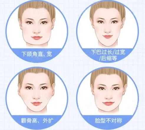 方脸削骨大概多少钱？价格表费用2023汇总！靠谱医院分享~