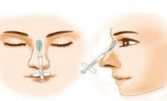 濡白天使隆鼻后多久恢复?5-7天恢复~效果一般可持续24个月~ 濡白天使隆鼻后多久恢复?5-7天恢复~效果一般可持续24个月~