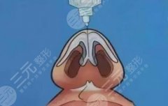 濡白天使打鼻子多久定型?濡白天使维持时间、价格、优势科普 濡白天使打鼻子多久定型?濡白天使维持时间、价格、优势科普