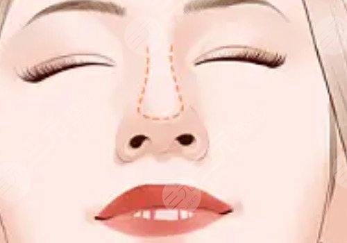 叶丽萍做鼻子怎么样？