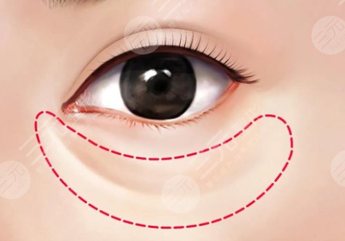 泪沟是怎么形成的？