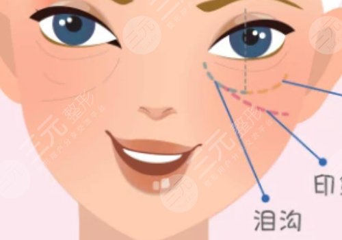 泪沟是怎么形成的？