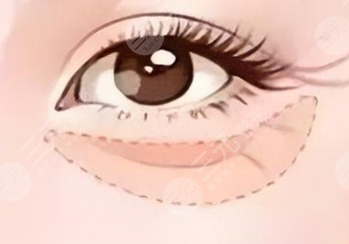 泪沟是怎么形成的？