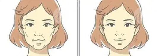 筋膜提拉术之后需要注意什么?