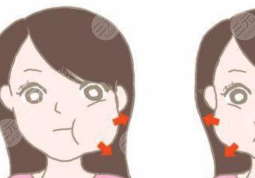 咬肌太大怎么办如何让咬肌变小？