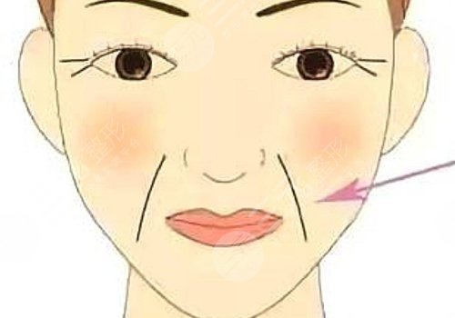 法令纹太深了有什么解决办法？