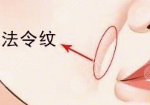 法令纹太深了有什么解决办法？