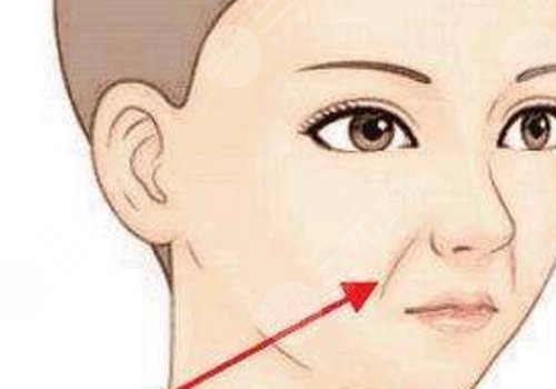 法令纹太深了有什么解决办法？