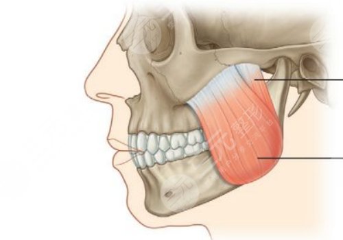 咬肌太大怎么办如何让咬肌变小？