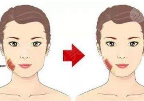 咬肌大怎么瘦下来