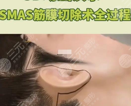 筋膜提升