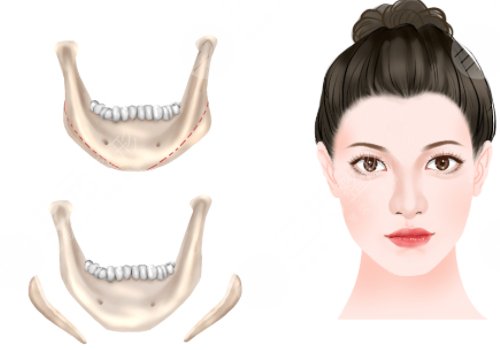 下颌角手术后头套要戴多久？3-4周的时间？