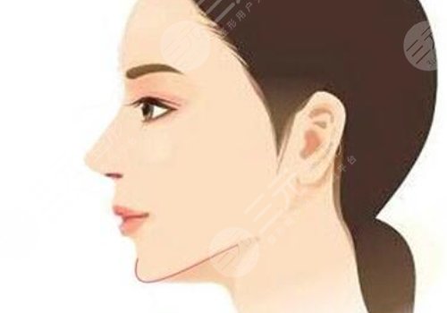 下颌角手术后头套要戴多久？