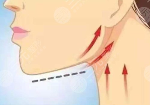 下颌缘提升怎么打？