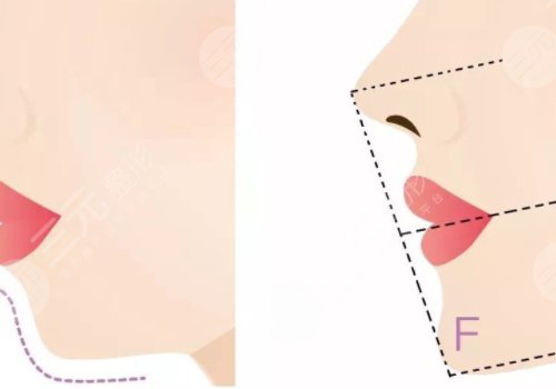 下颌缘提升怎么打？