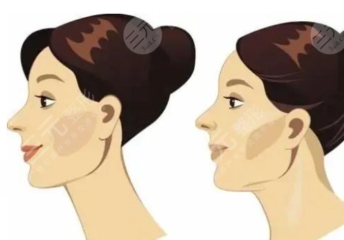 下颌缘提升怎么打？