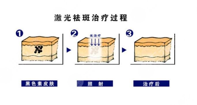 龙岗区人民医院祛斑多少钱?