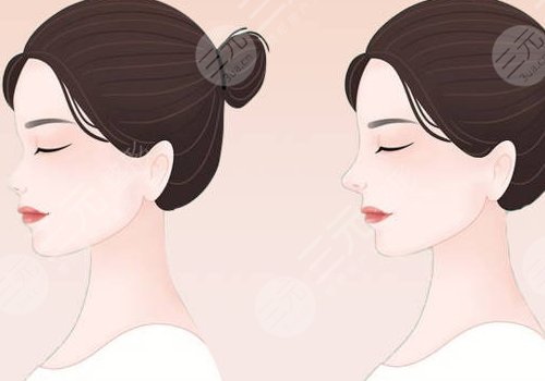 俞积贵做鼻子怎么样？