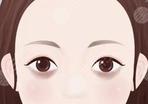 去黑眼圈手术多少钱啊？