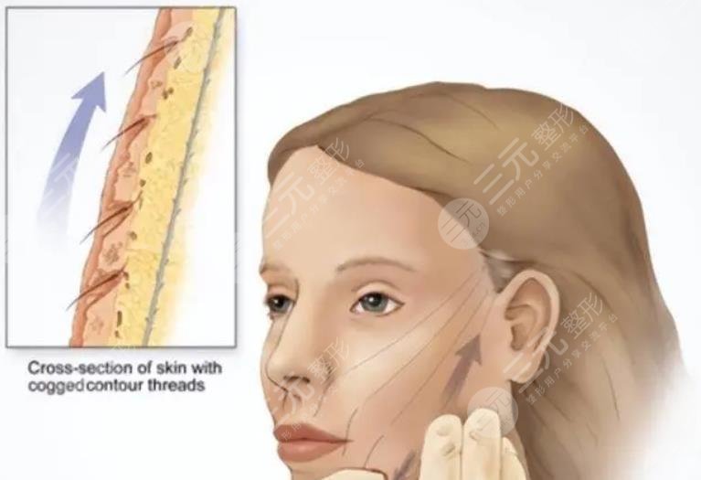 吴佳君医生拉皮手术案例