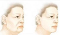做大拉皮手术需要多少?了解拉皮适合年龄、维持时间|你适合吗? 做大拉皮手术需要多少?了解拉皮适合年龄、维持时间|你适合吗?