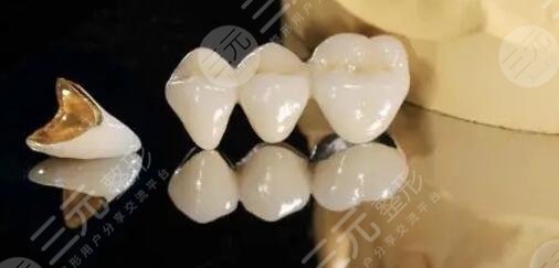 金钯烤瓷牙价格一般是多少?