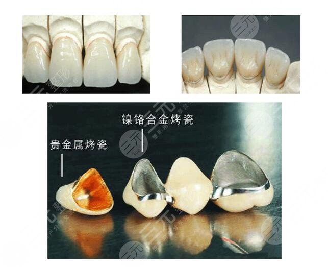 金钯烤瓷牙价格一般是多少?