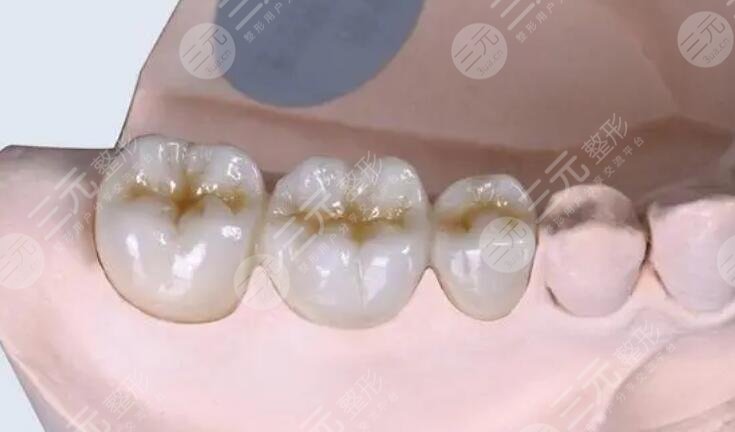 金钯烤瓷牙价格一般是多少?