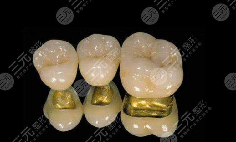 金钯烤瓷牙价格一般是多少?