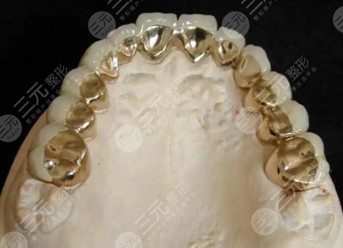 金钯烤瓷牙价格一般是多少?